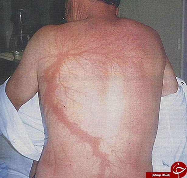 مرگ ناشی از برخورد صاعقه